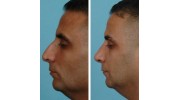 Rhinoplasty