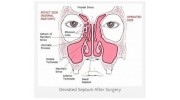 Deviated Septum